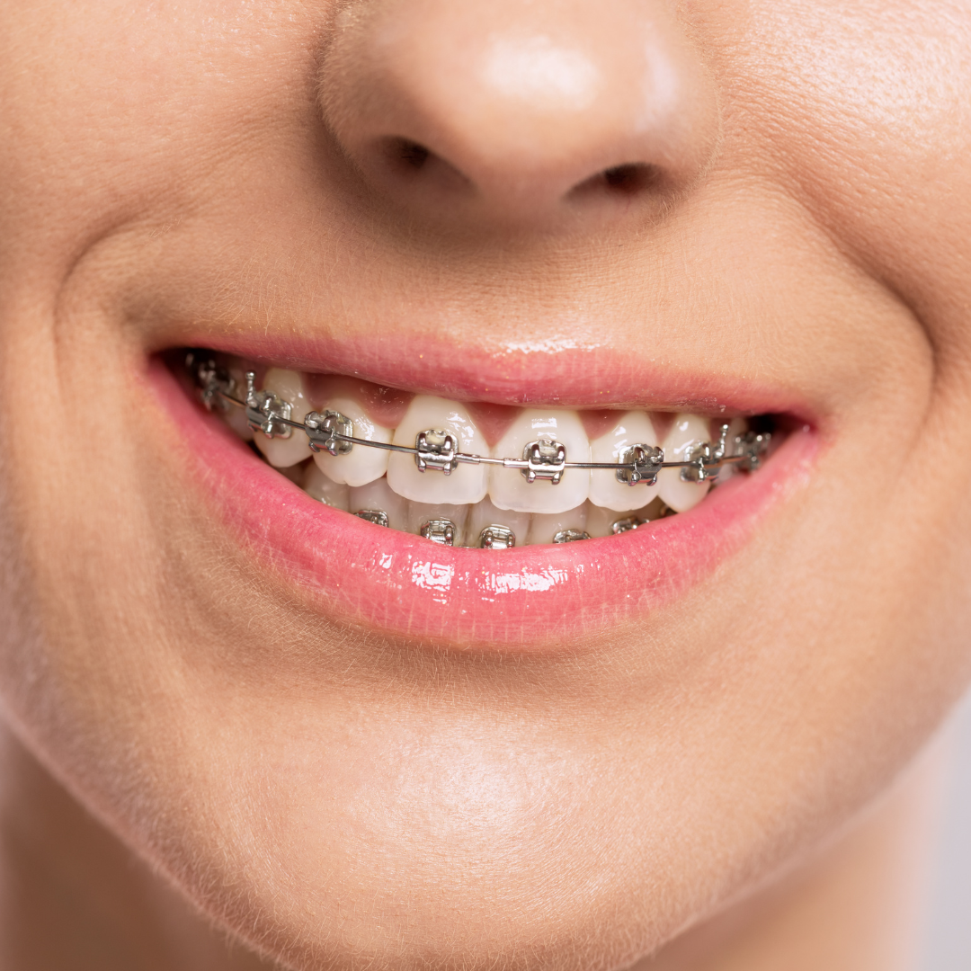 Orthodontic treatments in Vijayapura