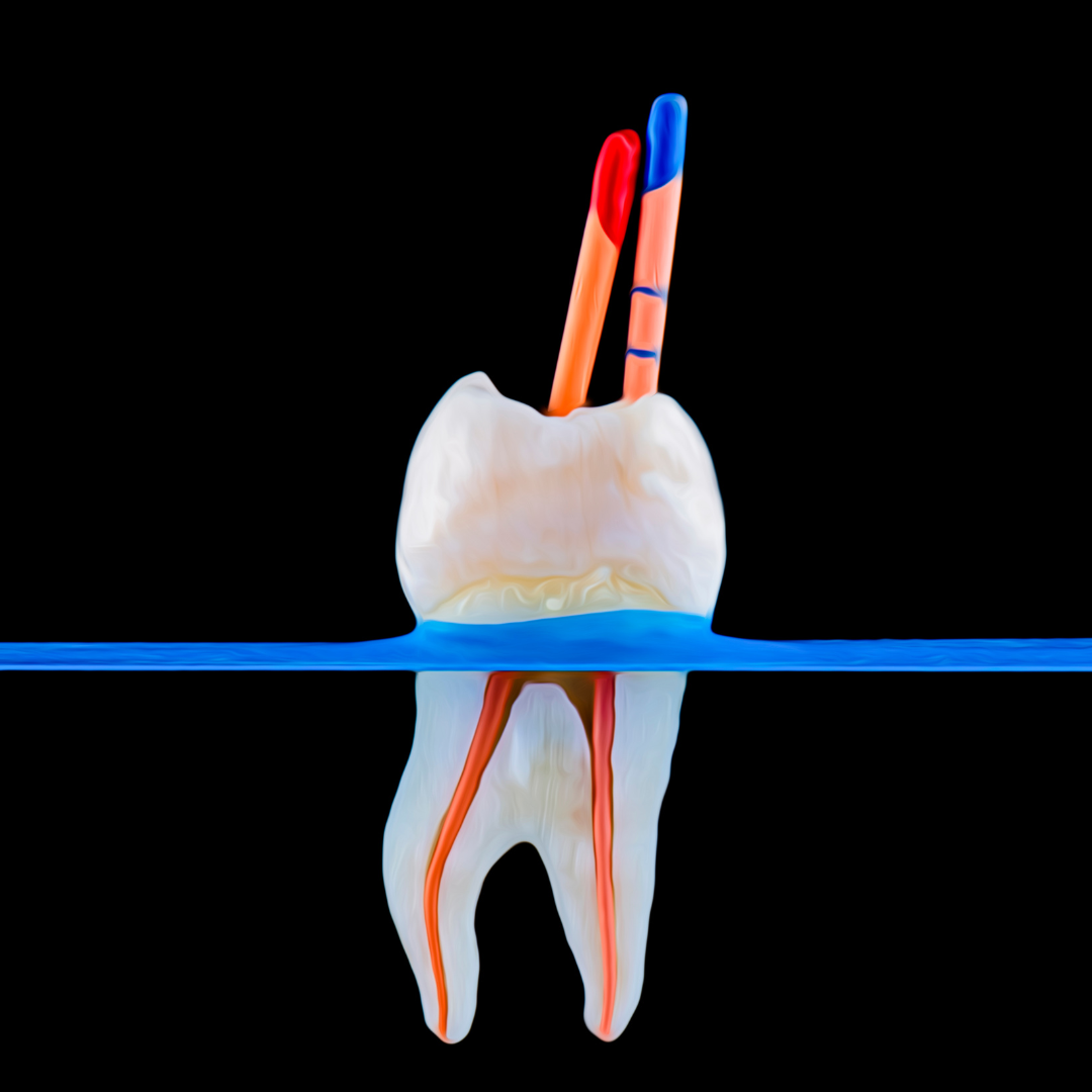Root canal treatment in Vijayapura