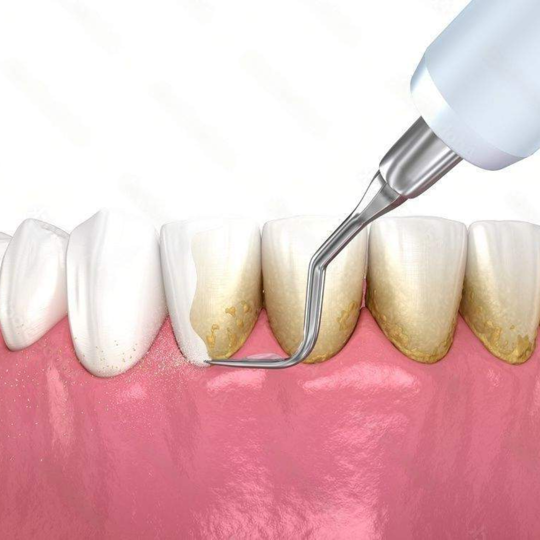 Teeth cleaning and polishing in Vijayapura