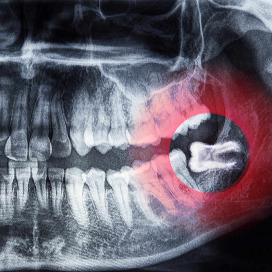 Wisdom tooth treatment in Vijayapura