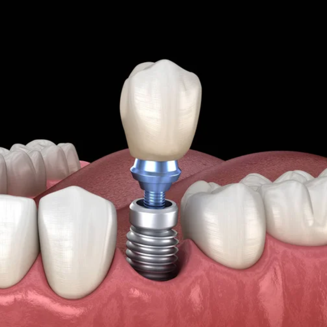 Dental implants in Vijayapura