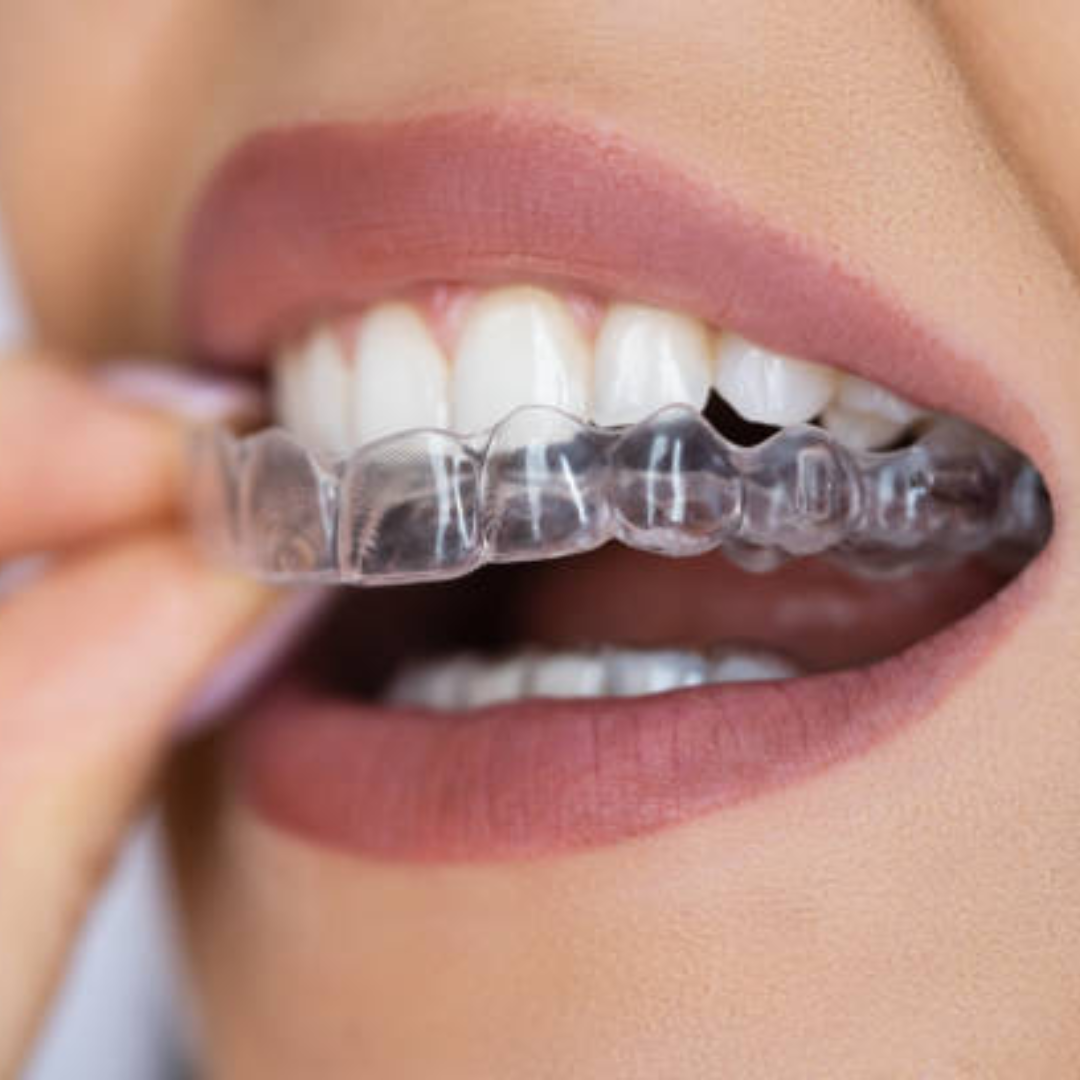 Invisible aligners in Vijayapura