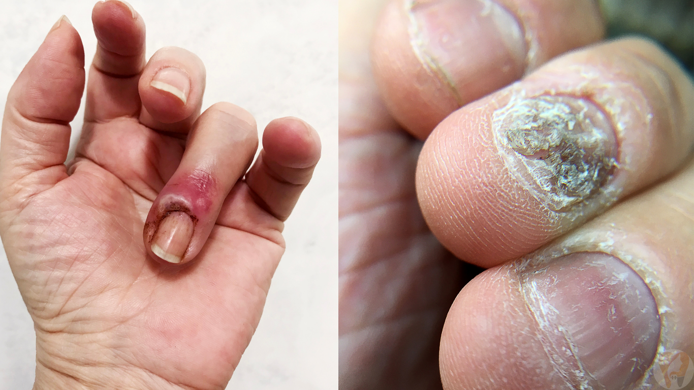Nail Disorders Treatment at Janagond Skin & Dental Clinic, Vijayapura