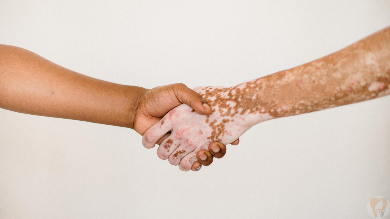 Vitiligo Treatment at Janagond Skin & Dental Clinic, Vijayapura