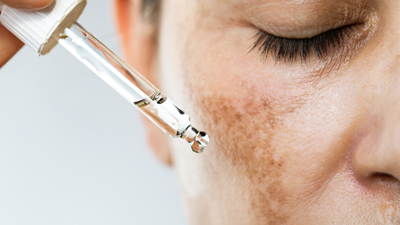 Pigmentation & Melasma Treatment at Janagond Skin & Dental Clinic, Vijayapura