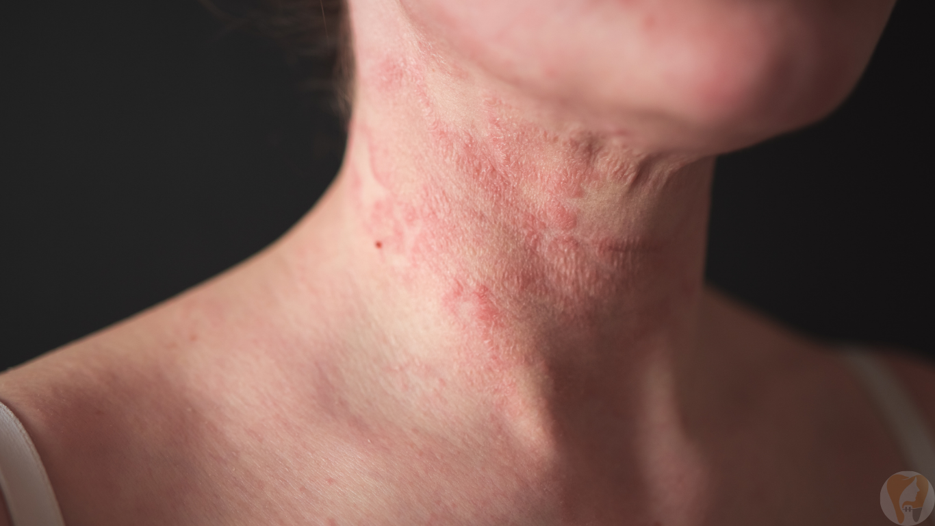 Eczema & Psoriasis Treatment at Janagond Skin & Dental Clinic, Vijayapura