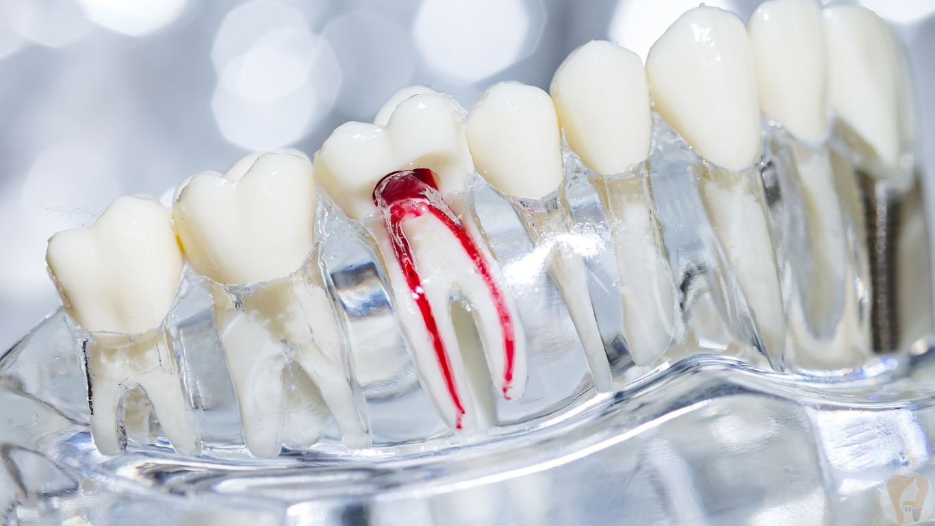 Root Canal Treatment at Janagond Skin & Dental Clinic