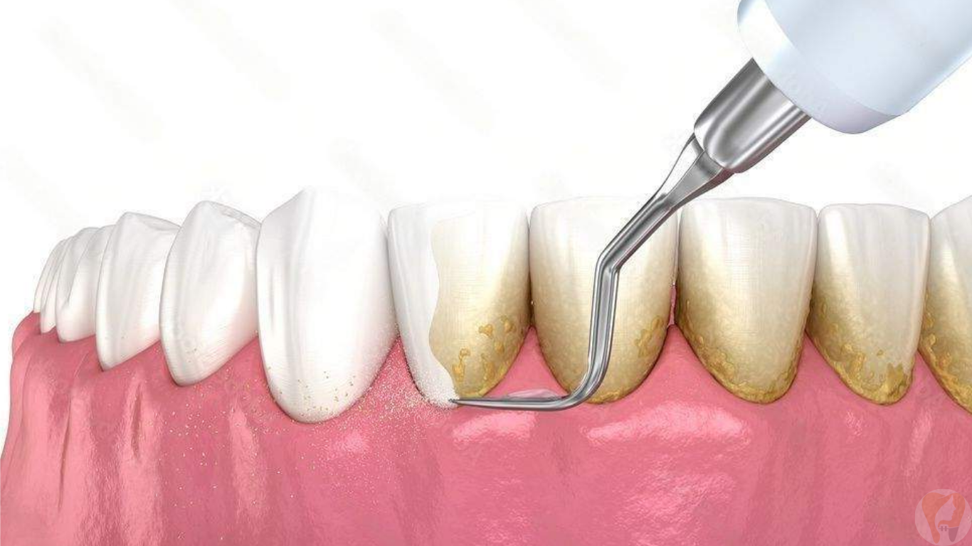 teeth cleaning and polishing in Vijayapura