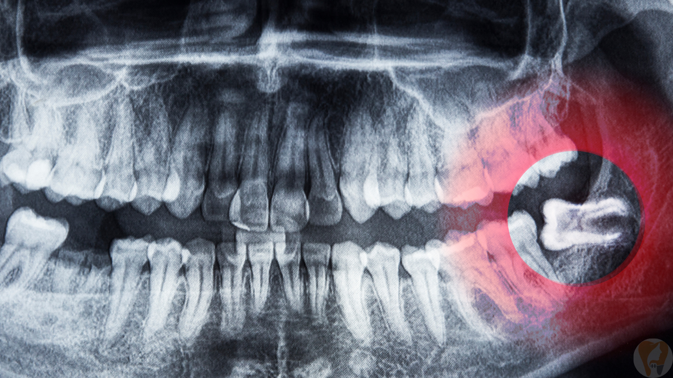 Wisdom Tooth Treatment at Janagond Skin & Dental Clinic