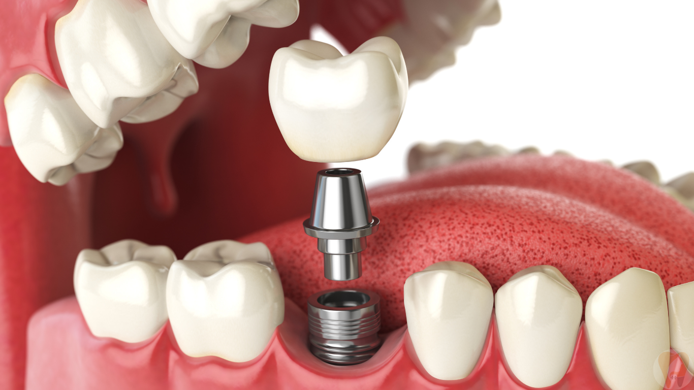 Dental Implants at Janagond Skin & Dental Clinic