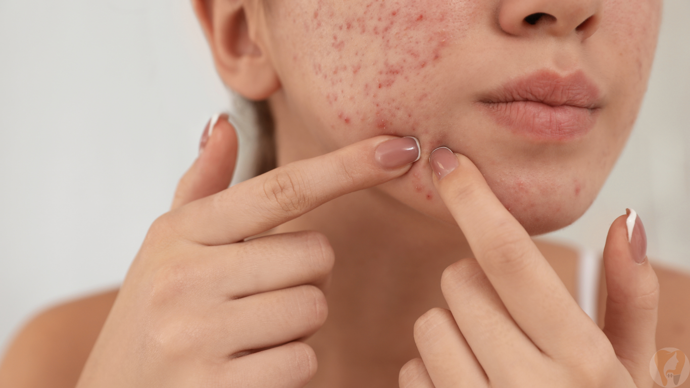 professional acne treatment at Janagond Skin & Dental Clinic, Vijayapura